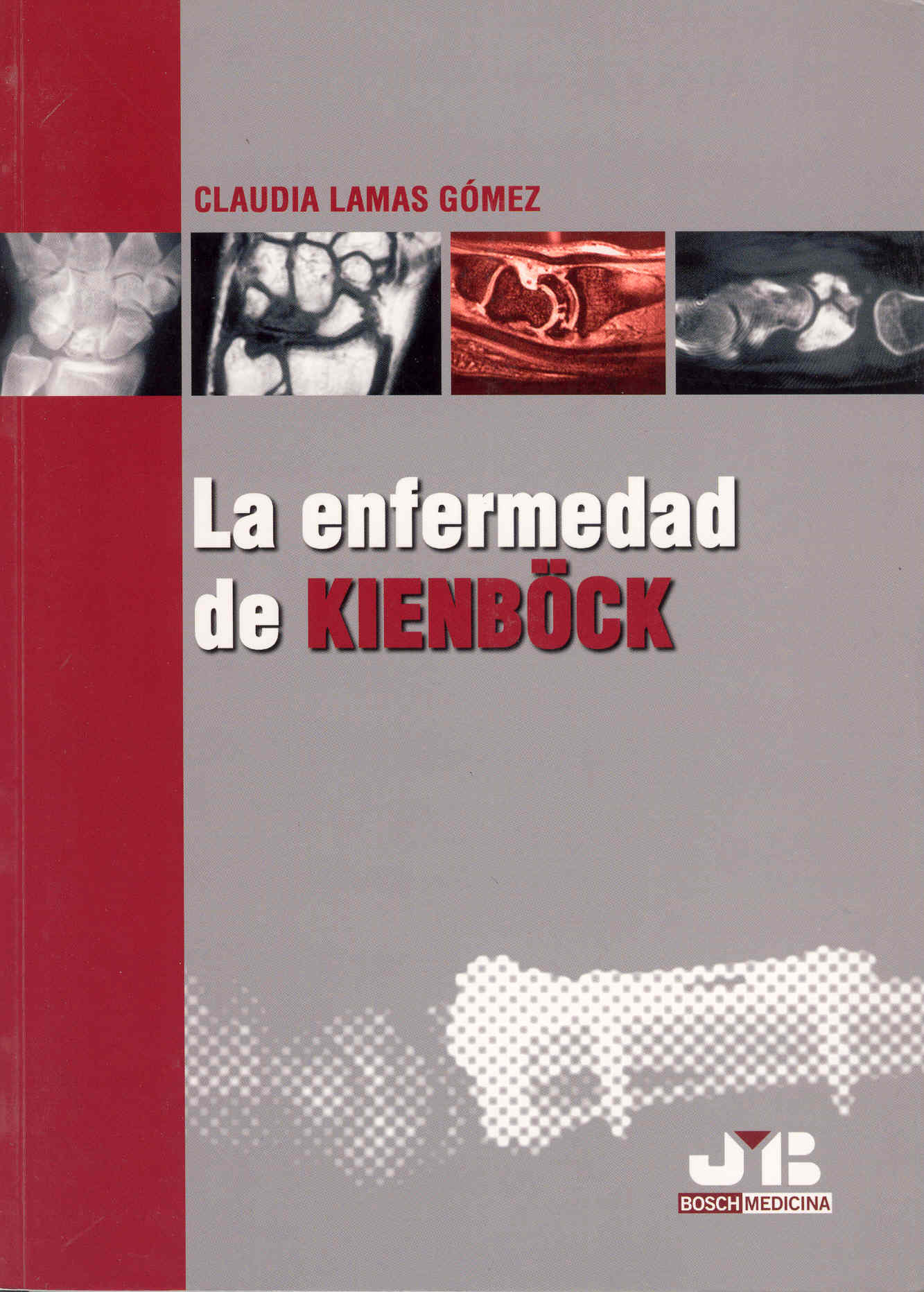 La enfermedad de Kienböck.